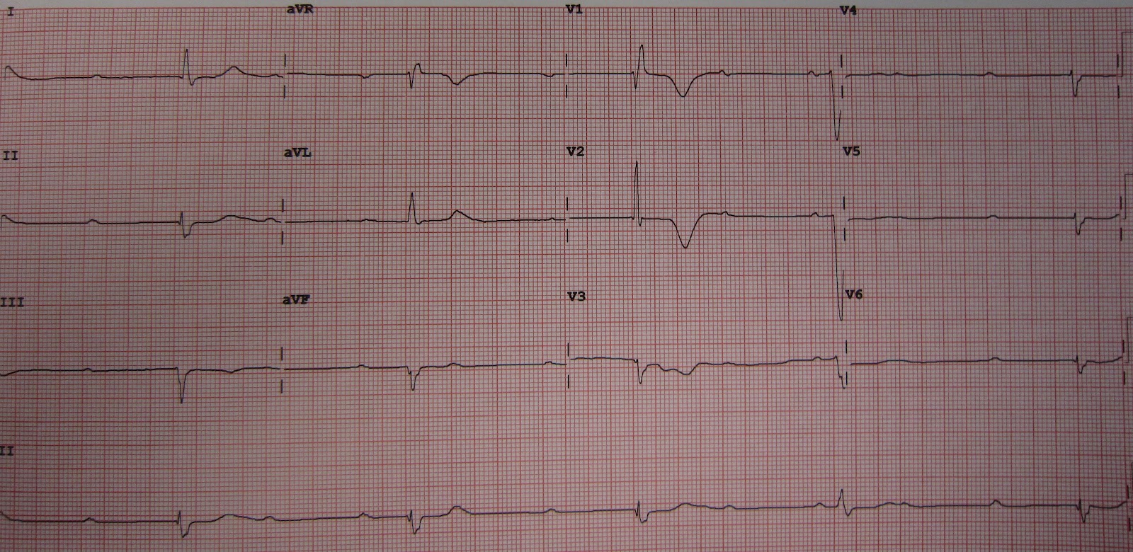 Note: P-P intervals equal, QRS-QRS intervals equal, heart rate 35
