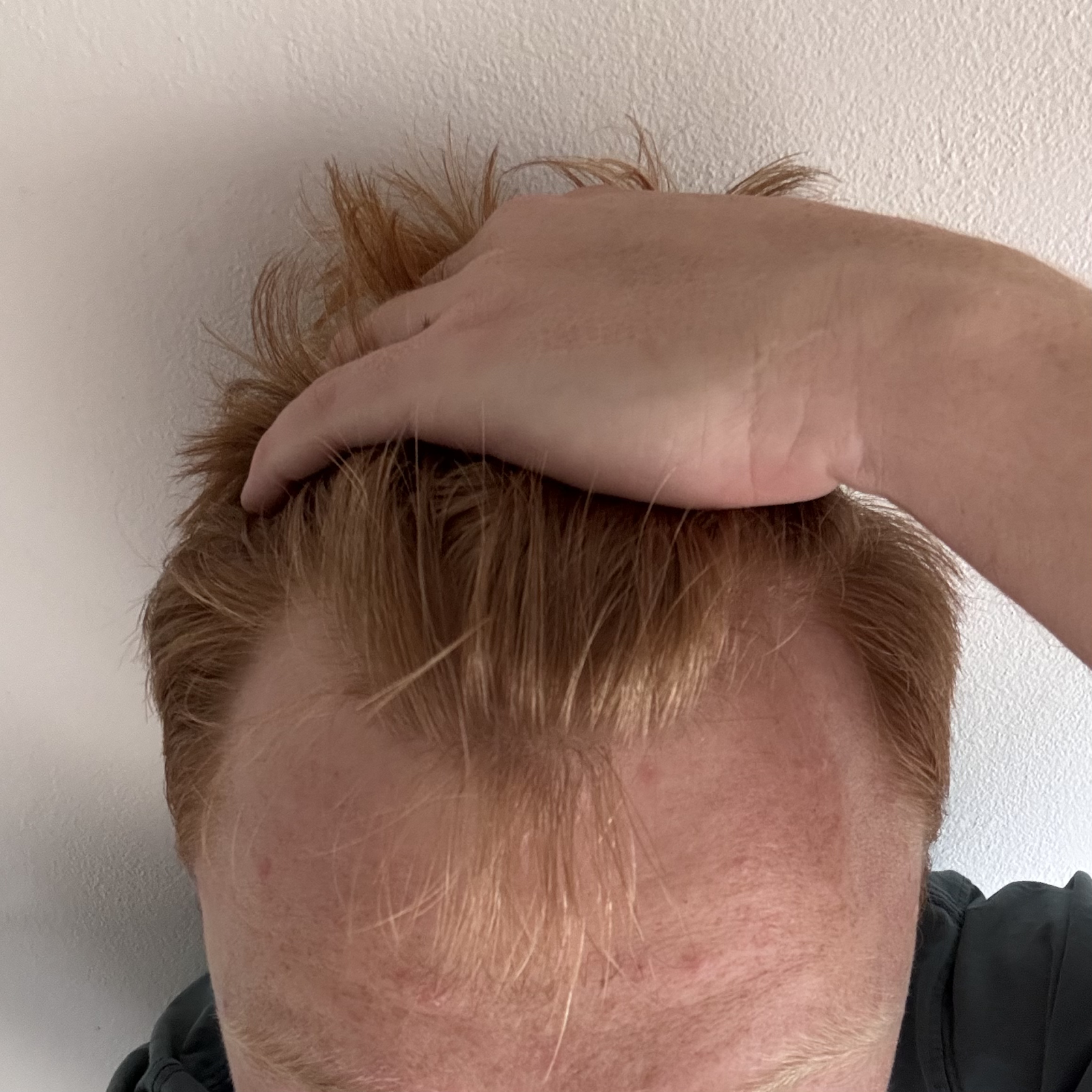 Upload a photo of your hairline, similar to the example image provided